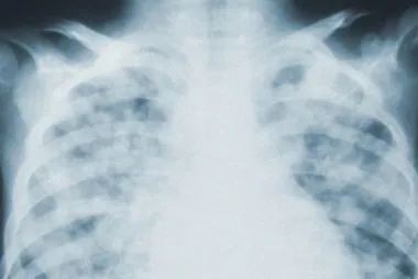 x-ray